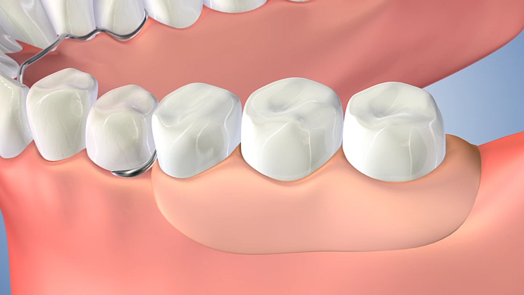 植牙醫療3D動畫製作